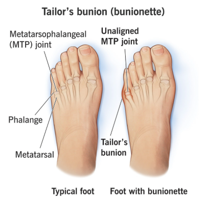 When In Doubt, Pinky Out: How Your Smallest Toe Shapes Balance, Posture, and Performance