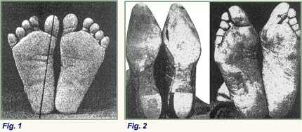 Unlocking Natural Foot Health: Combined Benefits of Toe Spacers & Barefoot Shoes